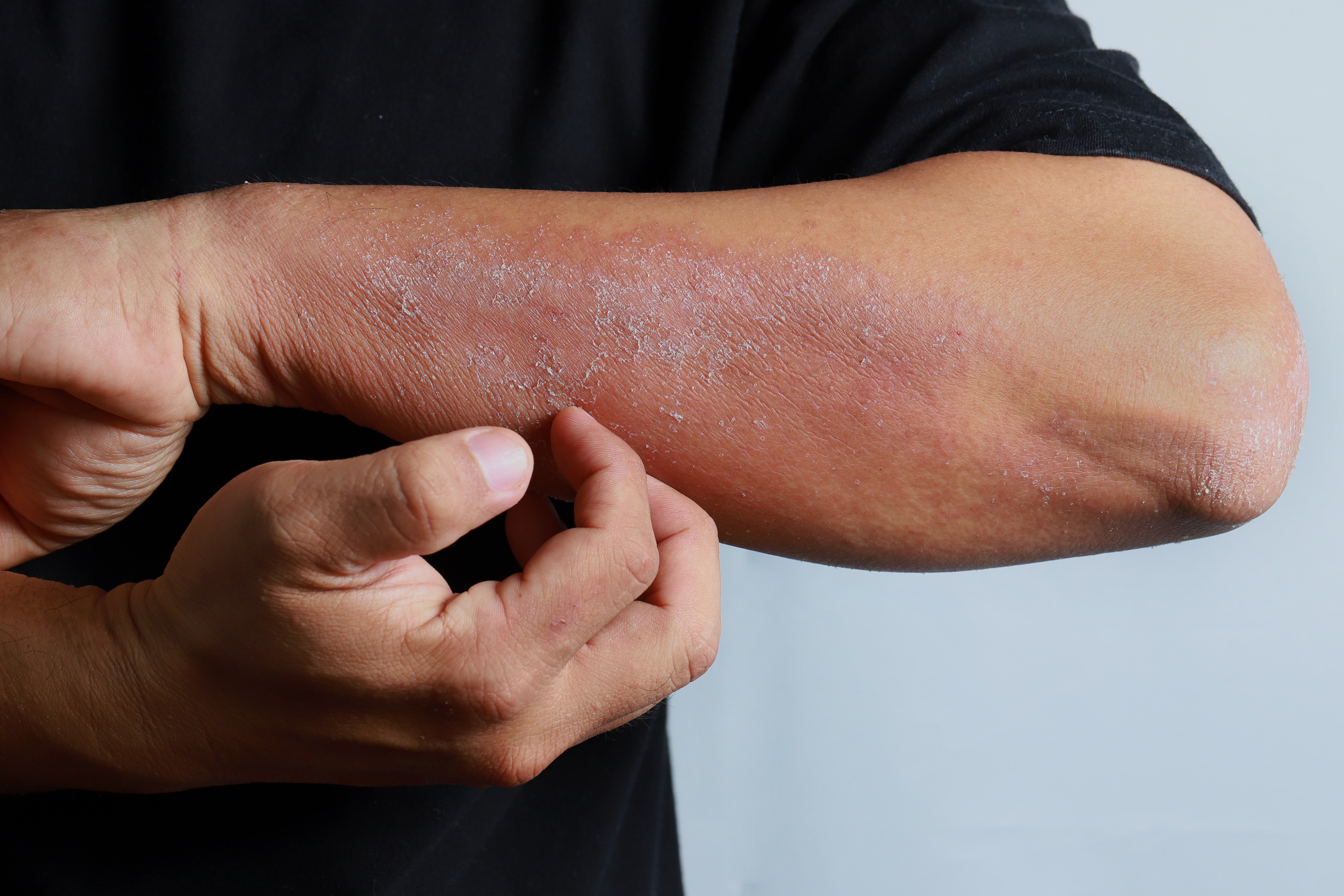 Man with eczema | Shutterstock