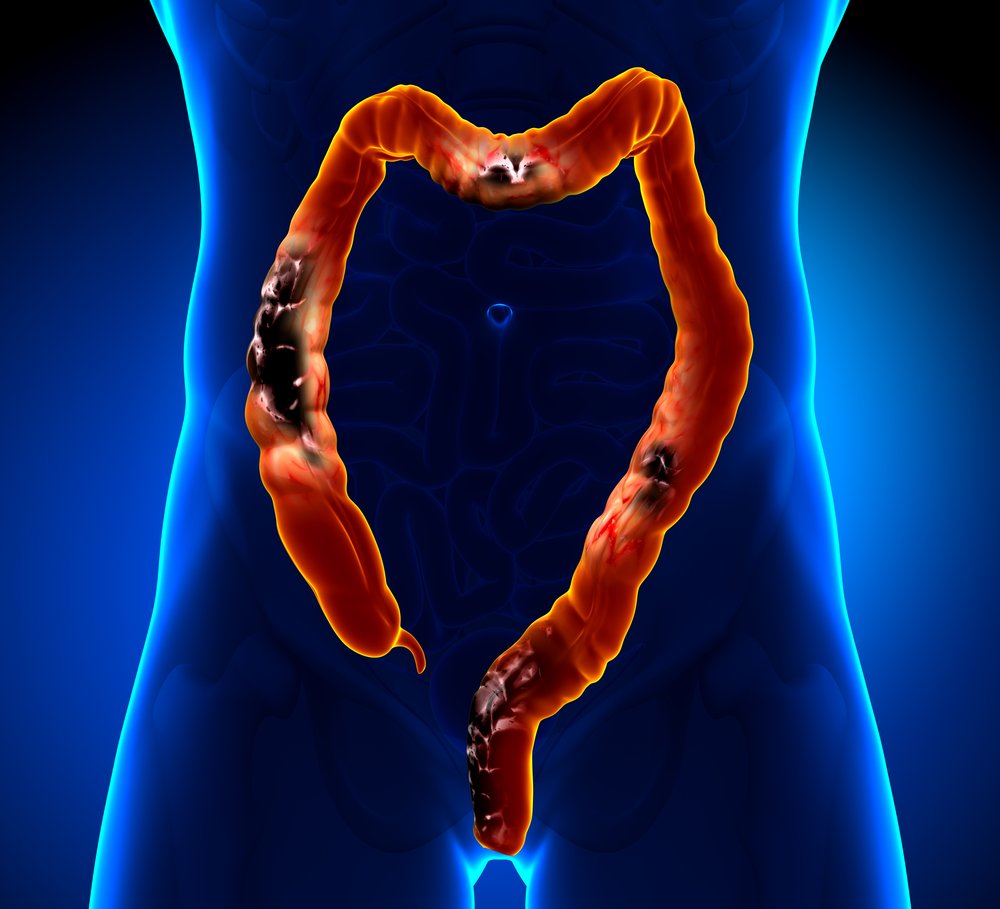 cancer colorectal / Source : Shutterstock cancer colorectal / Source : Shutterstock