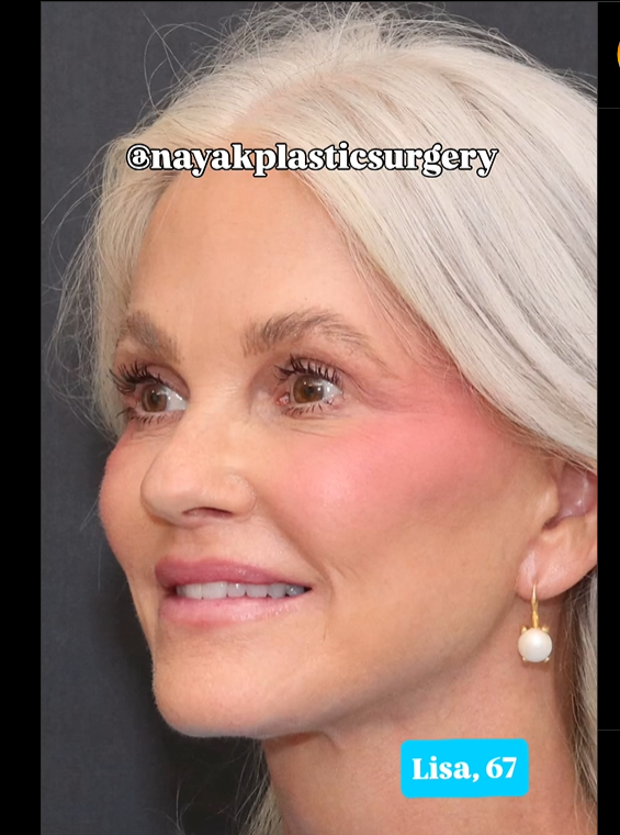 Lisa post surgery, as seen in a post dated June 1, 2025 | Source: Instagram/nayakplasticsurgery