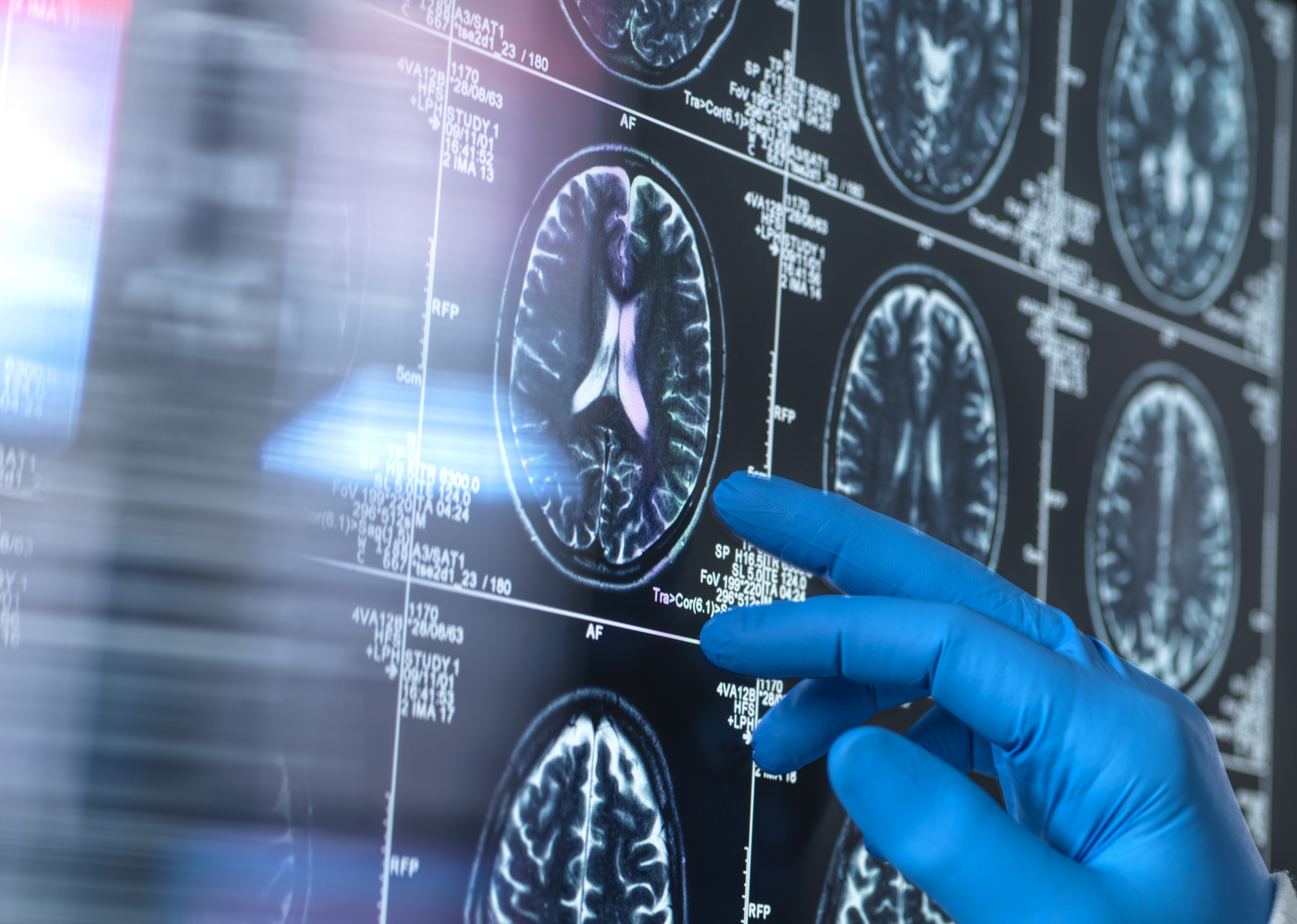 A scientist viewing a patient's brain magnetic resonance imaging (MRI) scan for ageing and damage due to dementia and Alzheimer's disease | Source: Getty Images