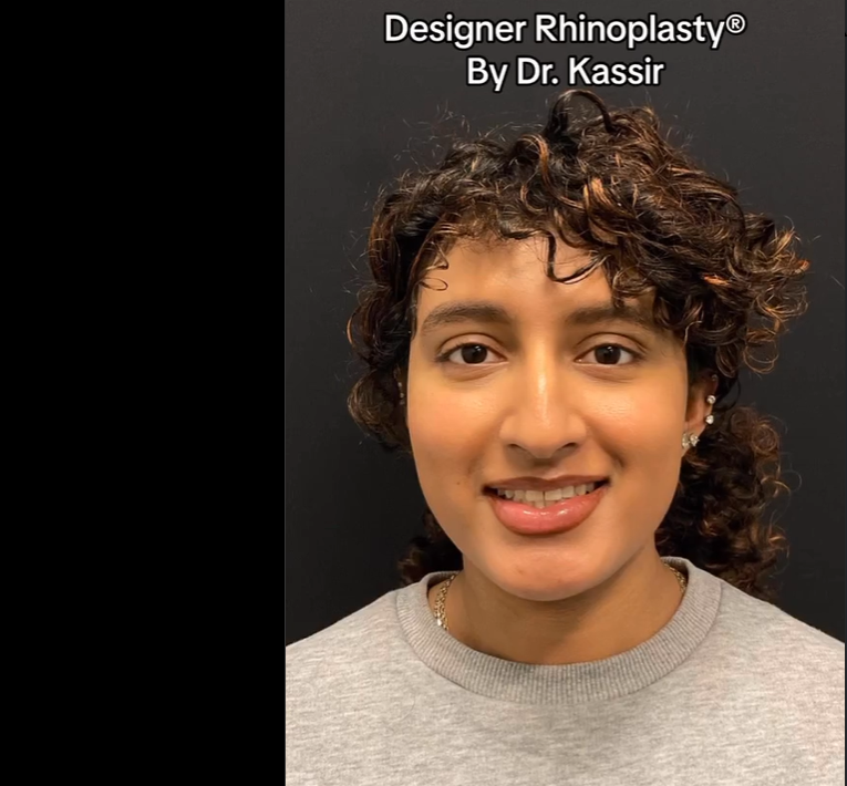A patient before rhinoplasty, dated August 24, 2023 | Source: Instagram/drkassir