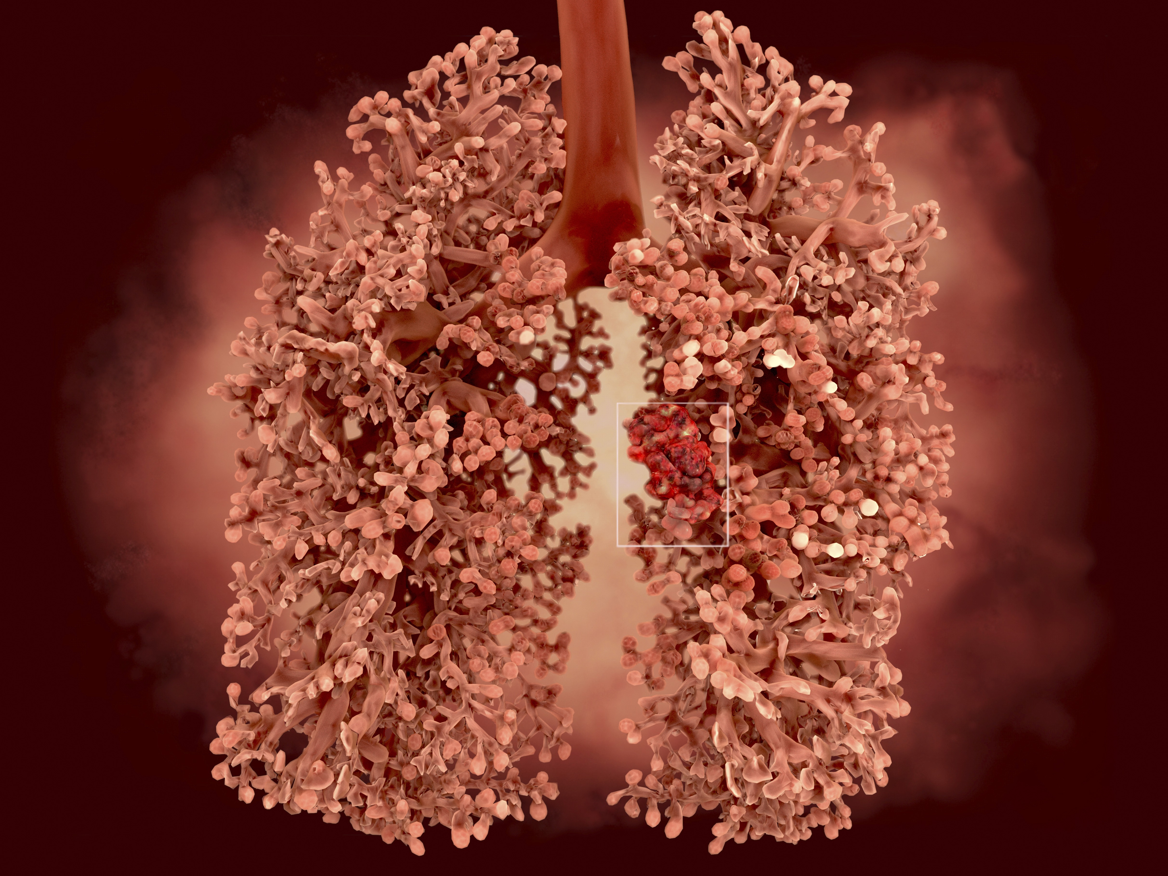 Artwork of a human lung and bronchi. | Source: Getty Images