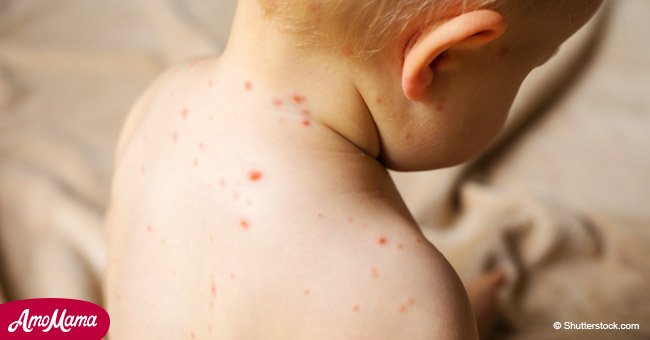 11-month-old boy suffers stroke after being infected with chicken pox by unvaccinated siblings