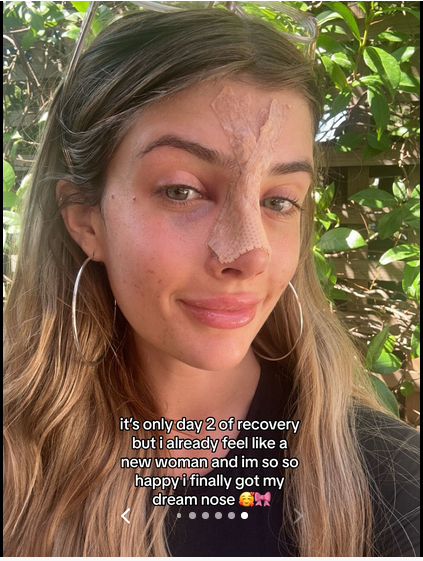 Sami Sheen shares her experience getting a nose job done, on a TikTok post dated August 13, 2024 | Source: Tiktok/@samisheen