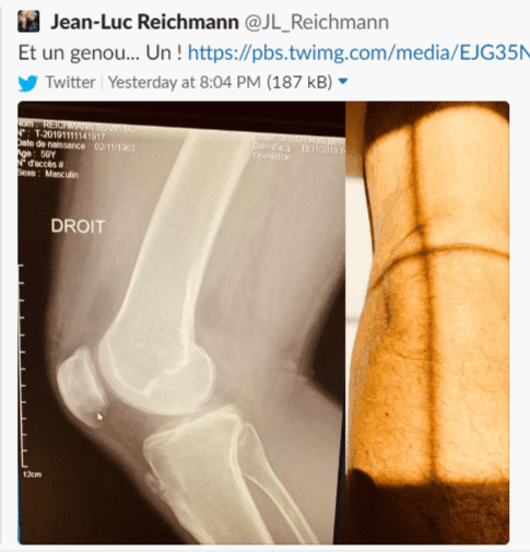 La jambe blessée de Jean-Luc Reichmann montrée en photo | Photo : Twitter La jambe blessée de Jean-Luc Reichmann montrée en photo | Photo : Twitter