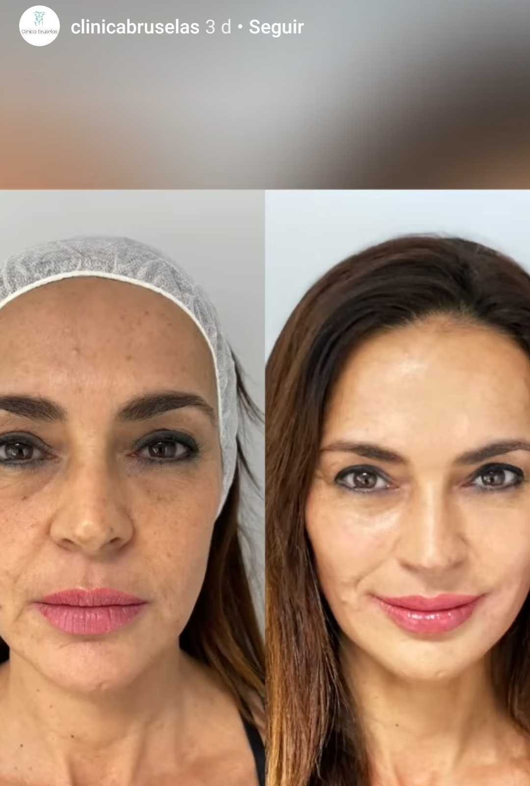 El antes y el después del tratamiento de Olga. │ Foto: Captura de Instagram/clinicabruselas 