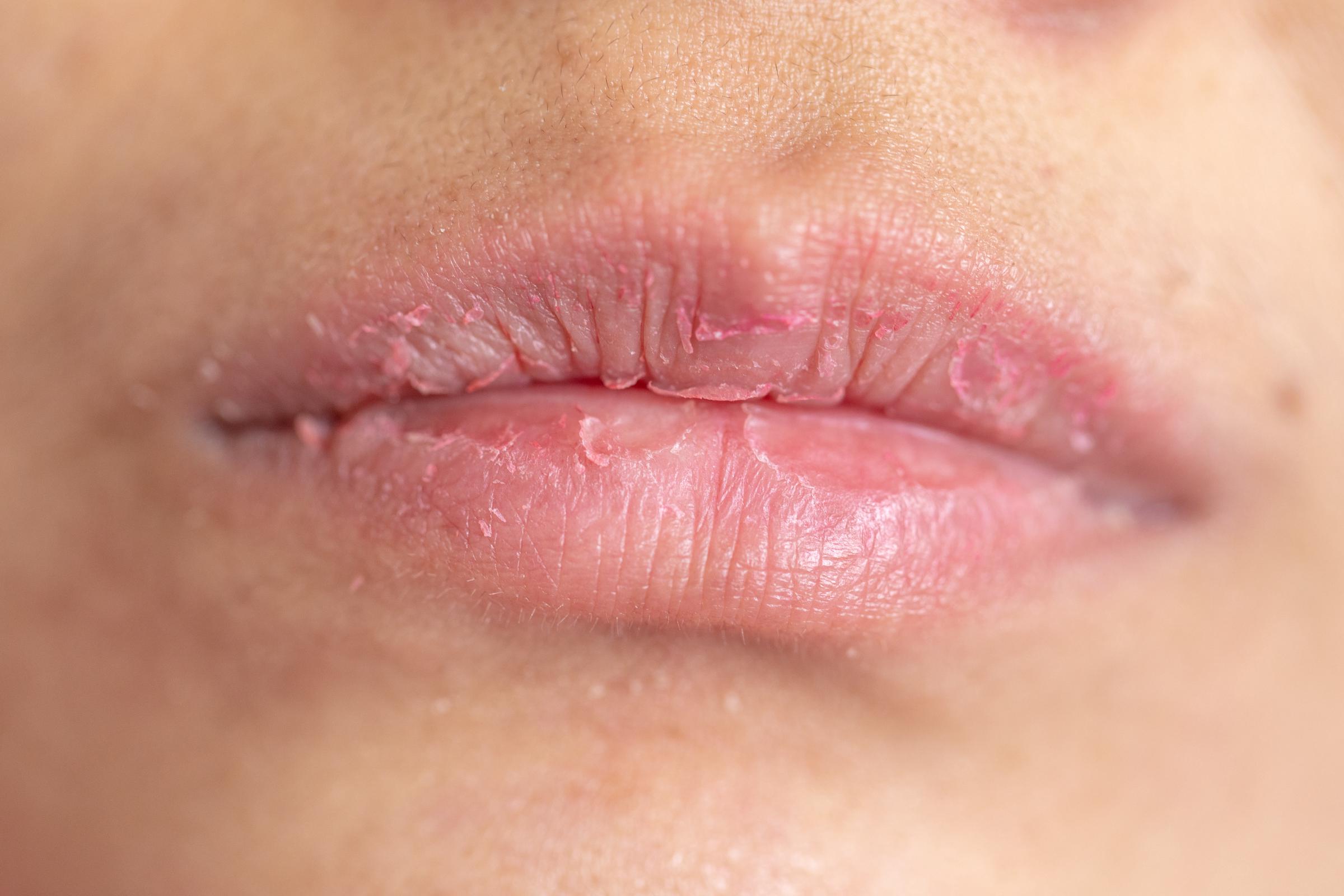 A woman with dry lips | Source: Getty Images