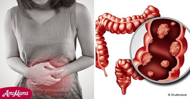 Colon cancer signs and symptoms everyone should know about