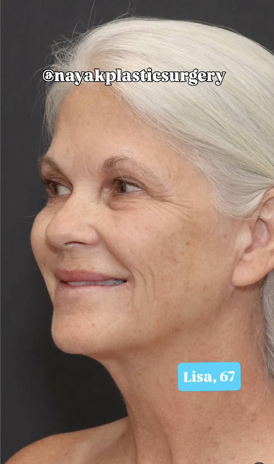 Lisa before surgery, as seen in a post dated June 1, 2025 | Source: Instagram/nayakplasticsurgery