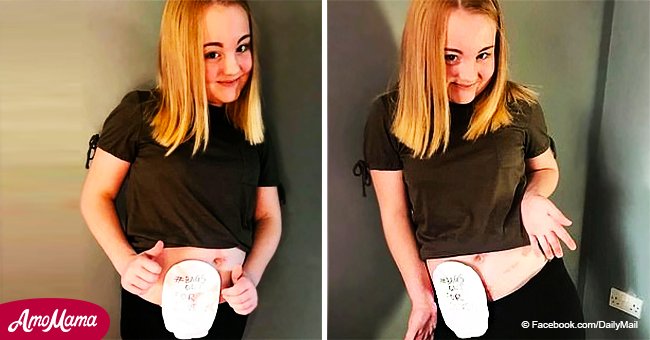 Teen shares proud pics of her stoma bag after boy with same disease killed himself over bullies