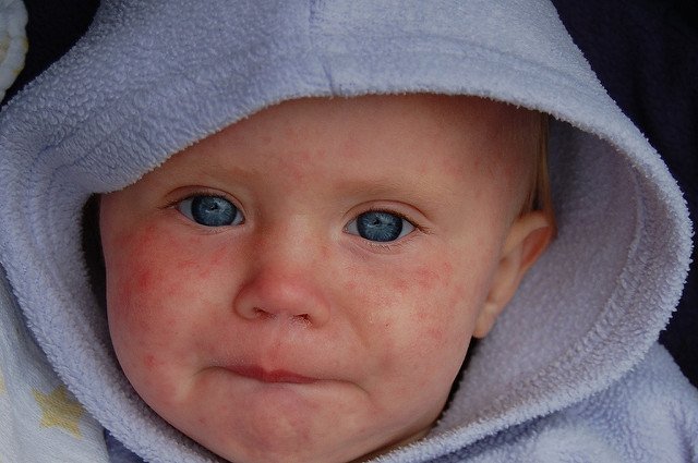 Little kid with measles. | Source: Flickr