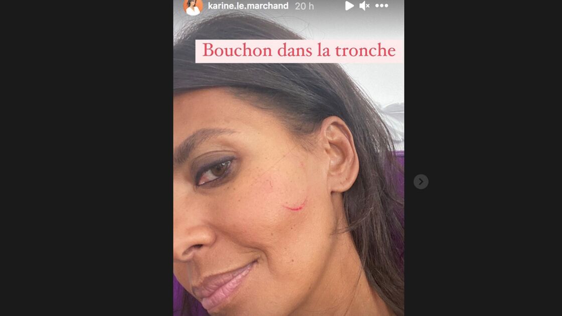 Visage blessé de Karine Le Marchand. | Photo : Instagram Story / Karine Le Marchand