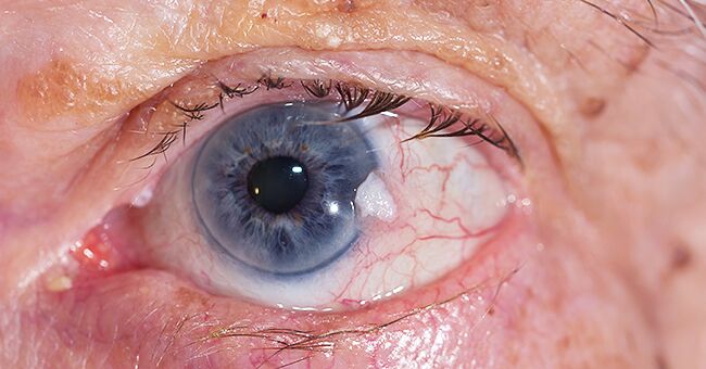 Oeil malade | Photo : Shutterstock Oeil malade | Photo : Shutterstock