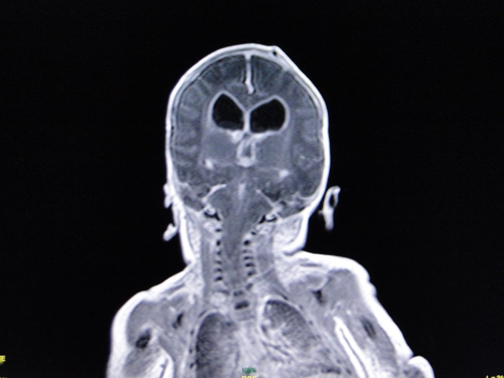 Malformación de Chiari tipo II.| Imagen: Flickr