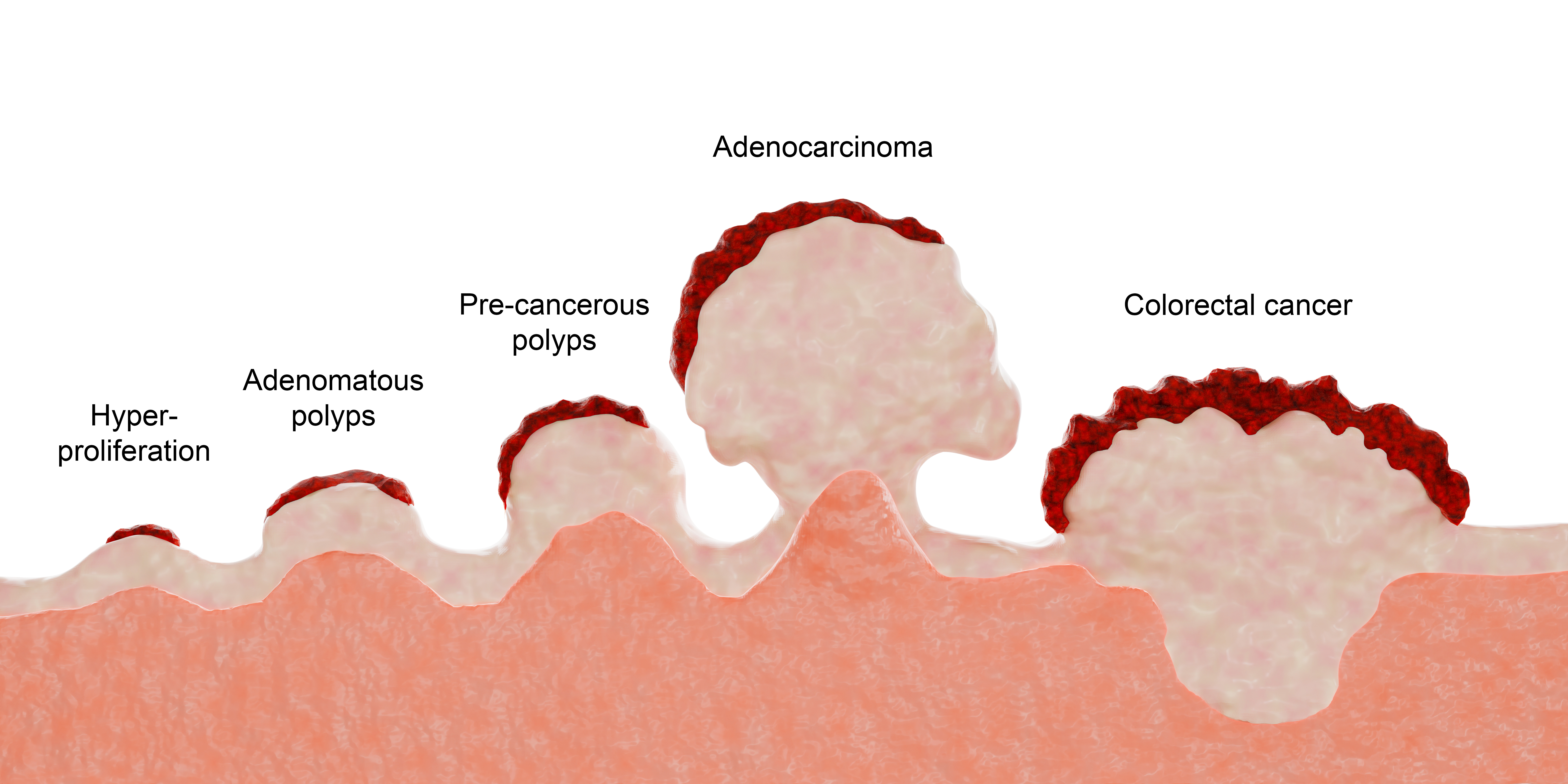 Illustration depicting the stages of colorectal cancer tumor development. The advanced stages, including adenocarcinoma, represent the transformation into a fully malignant condition | Source: Getty Images