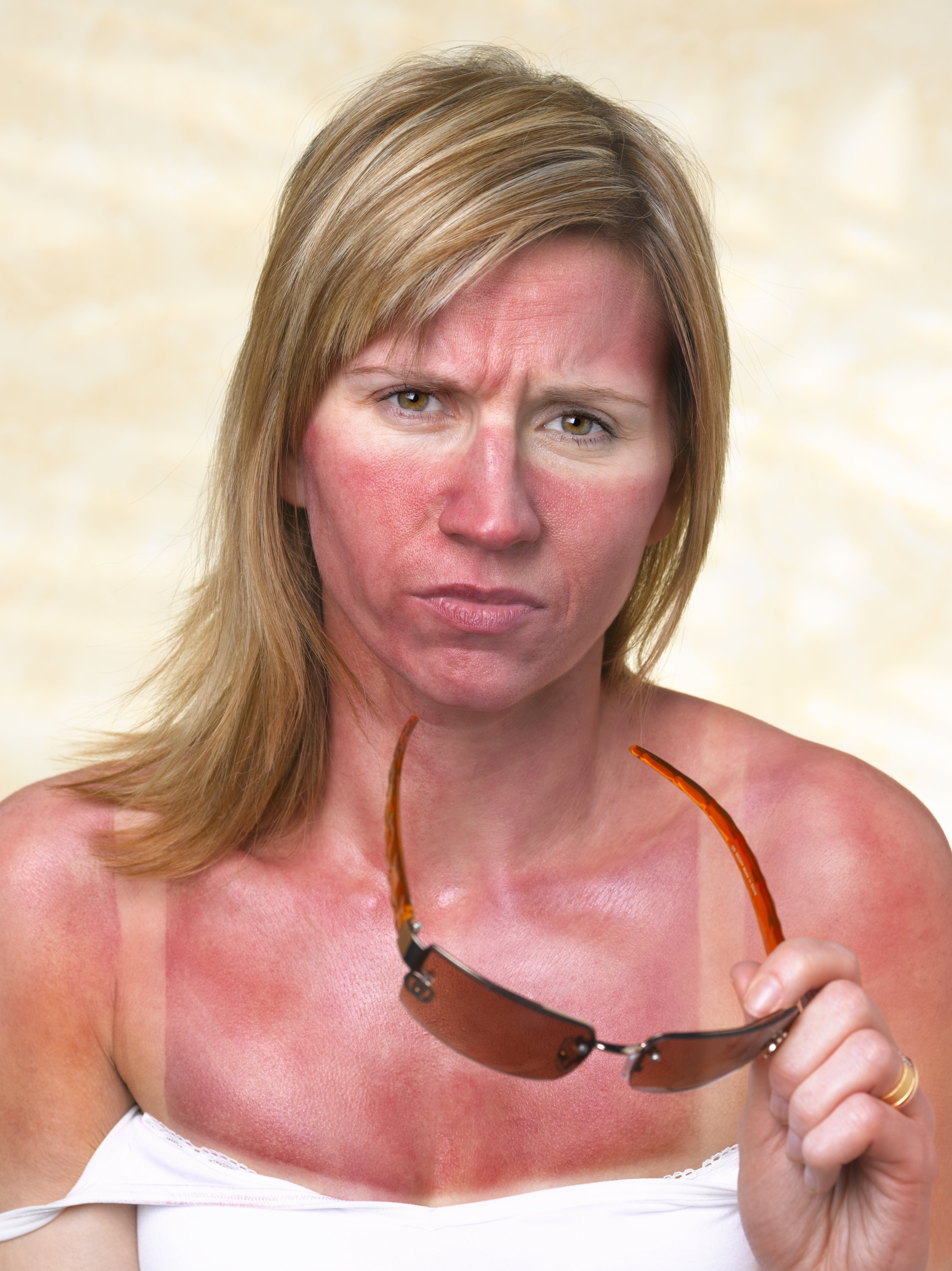 A woman with a sunburn. | Source: Getty Images