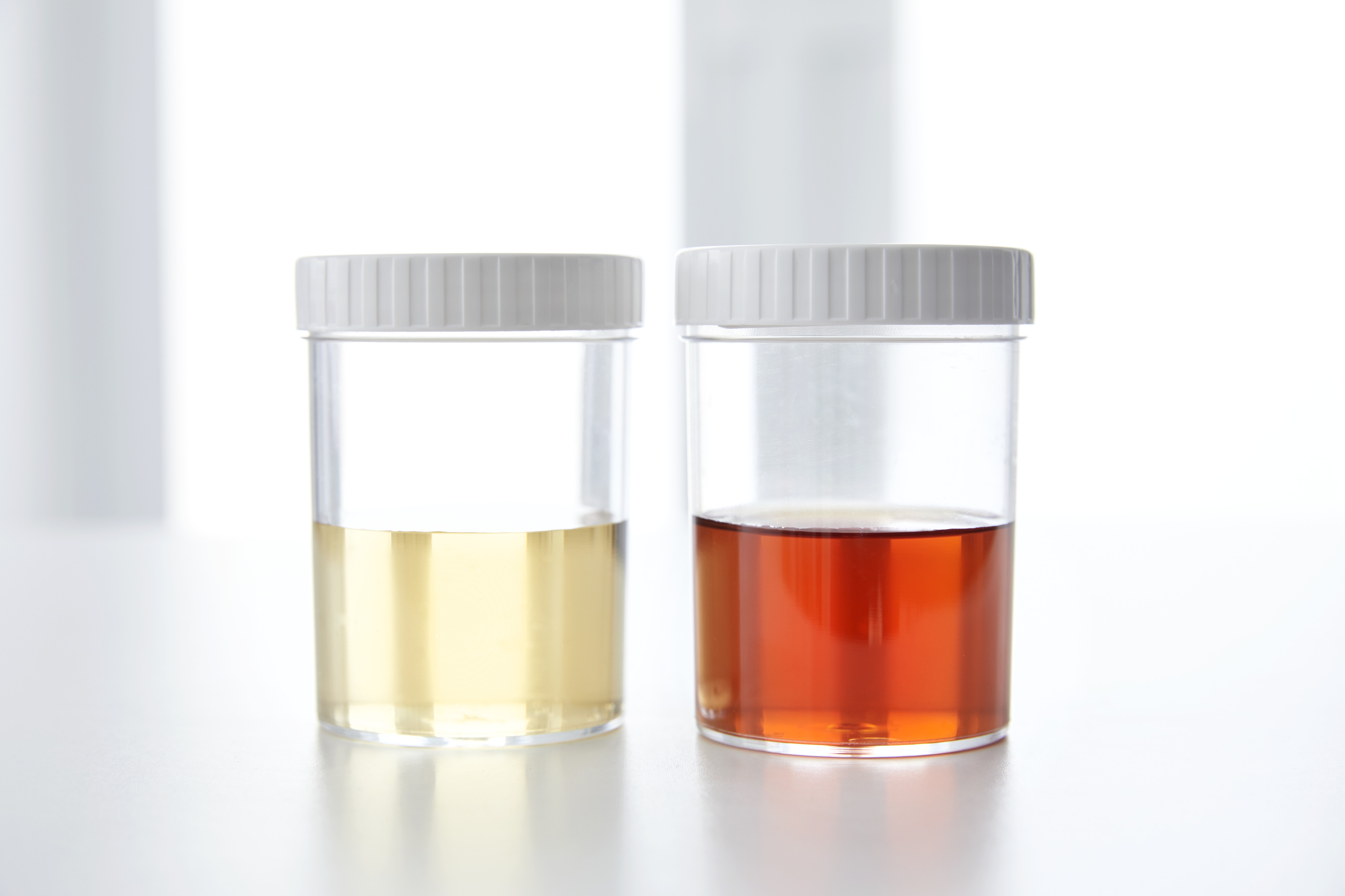 Blood in human urine in sample pot | Source: Getty Images