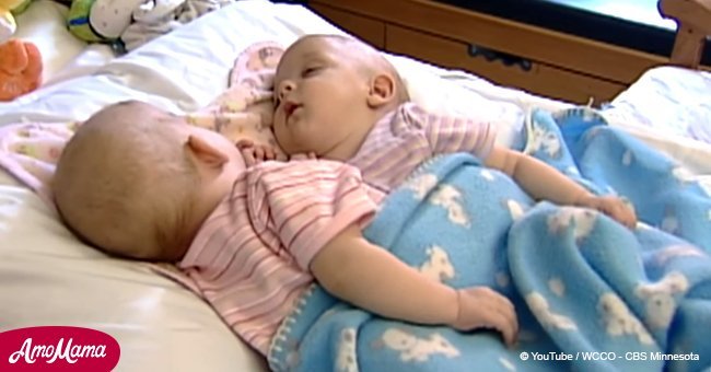 Conjoined twin girls were separated as babies. 10 years later, they look drastically different