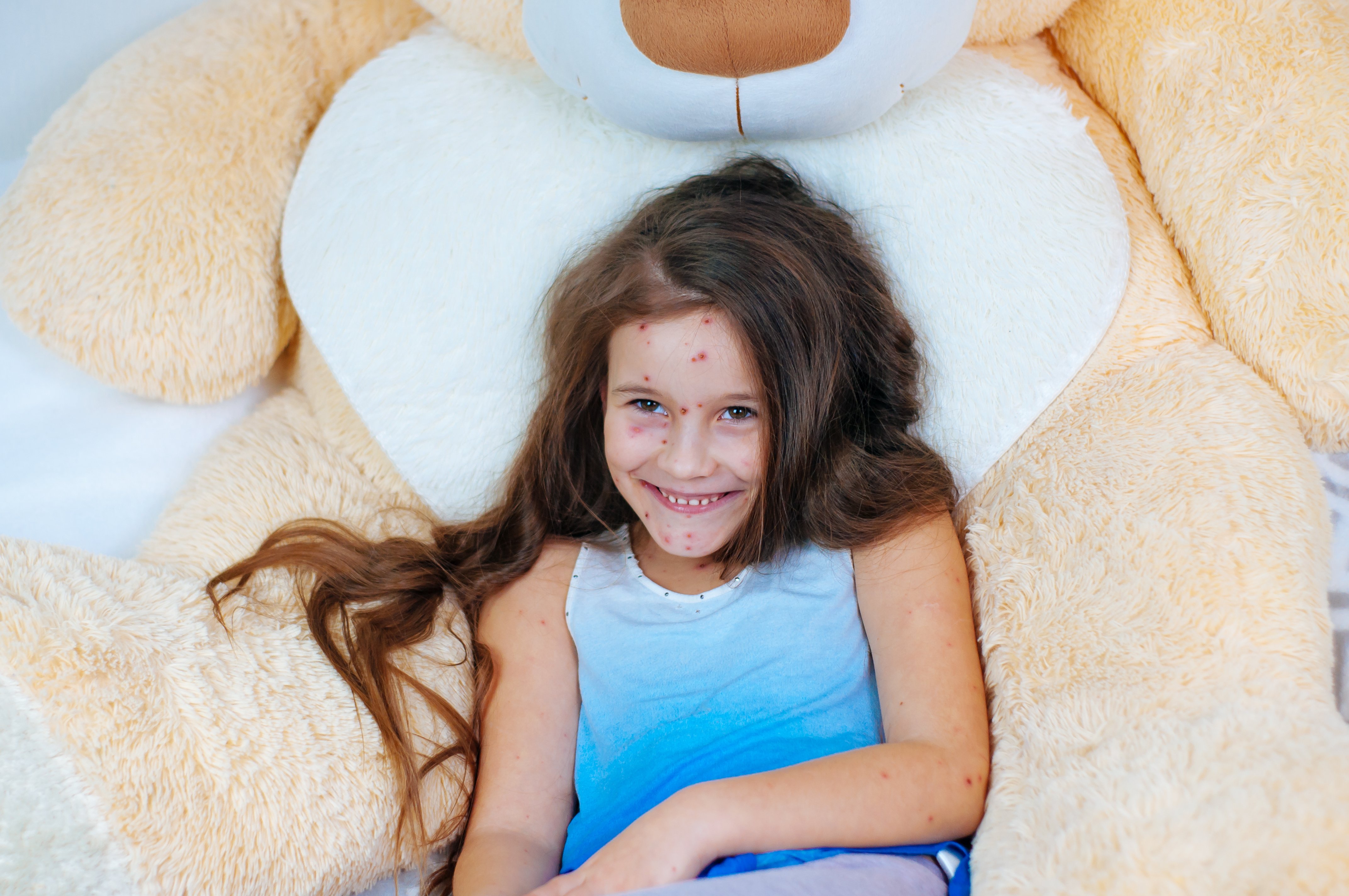 La varicelle chez l'enfant. | Photo : Shutterstock