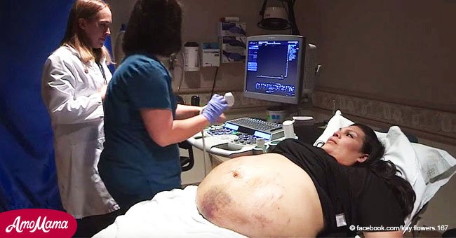 Mujer embarazada tiene hematomas en su panza. Viendo la ecografía, el médico queda perplejo