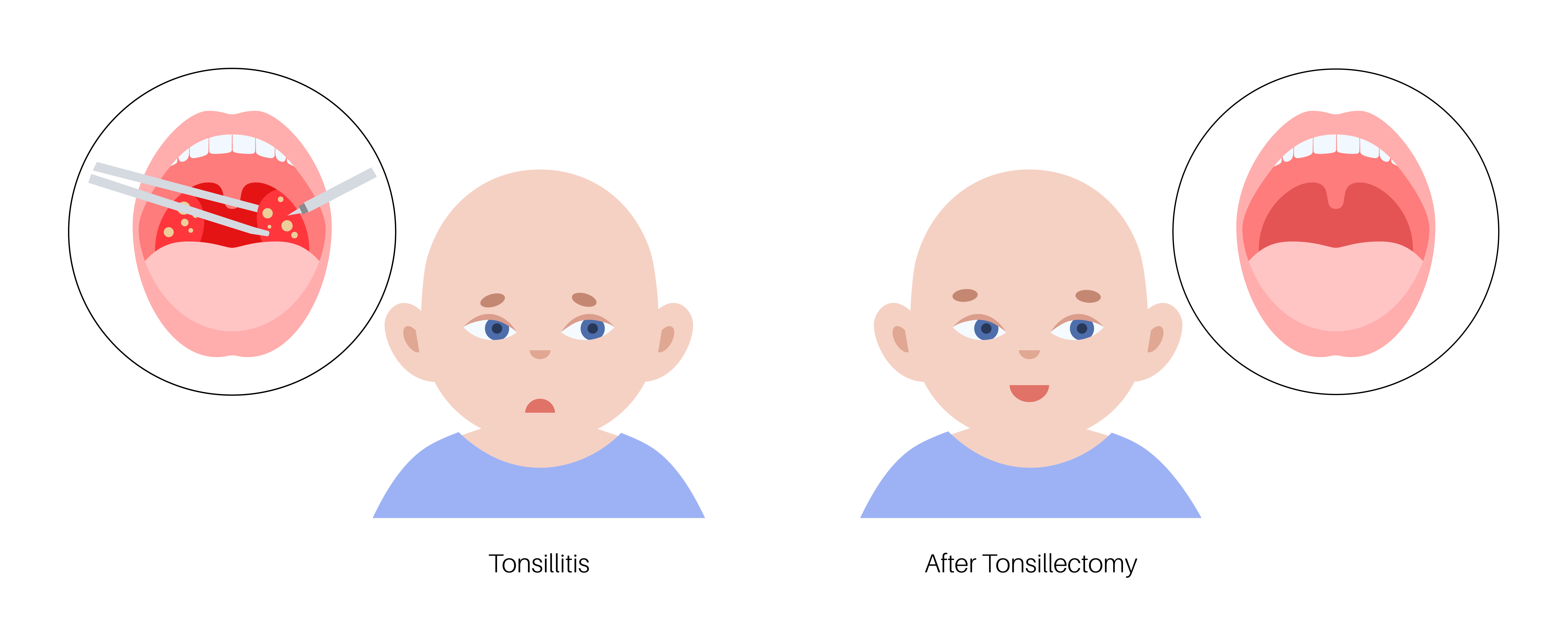 Illustration showing enlarged tonsils before surgery and the throat after a tonsillectomy. The procedure, which typically takes 20 to 30 minutes, is one of the most common surgeries performed on children in the United States, with more than 530,000 performed each year on patients under 15. | Source: Getty Images