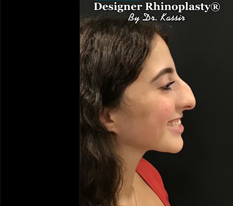 Patient before rhinoplasty, dated June 15, 2022 | Source: Instagram/drkassir