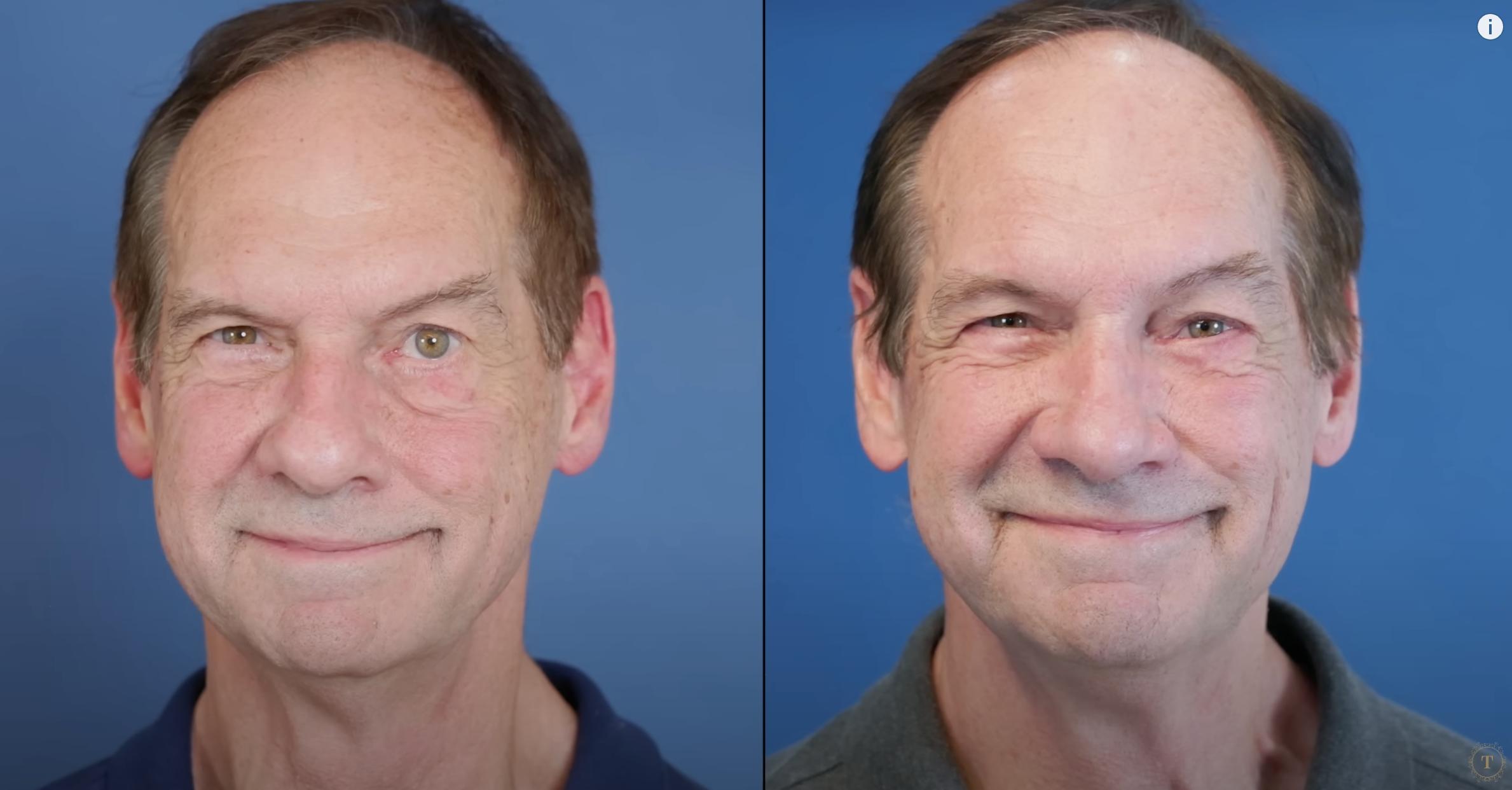 Barry Wolf before and after surgery | Source: YouTube/@Dr.Truesdale