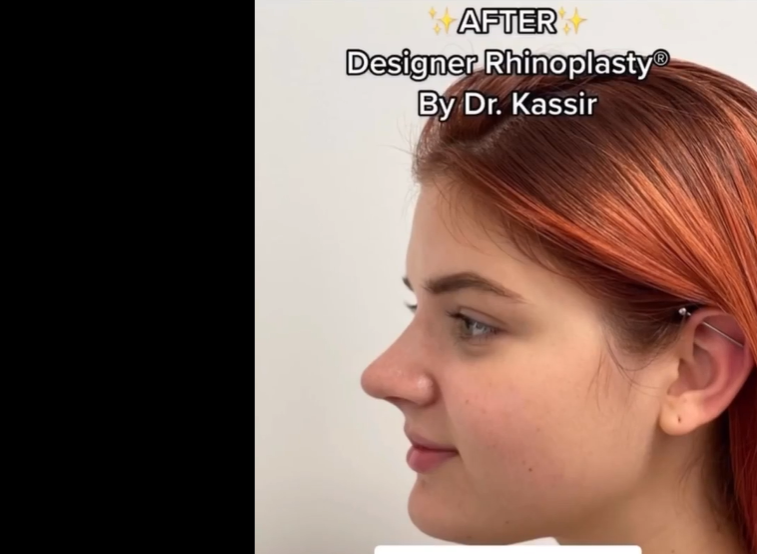 Patient pictured after rhinoplasty, dated September 30, 2022 | Source: Instagram/drkassir