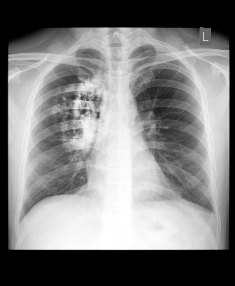 Cáncer de pulmón. Fuente: Shutterstock