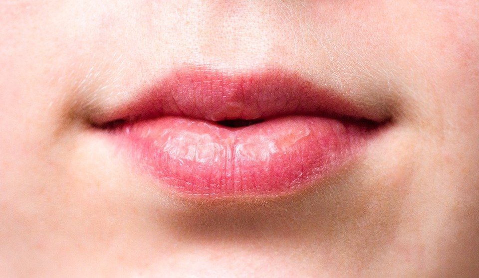 Labios escamosos / Imagen tomada de: Pixabay