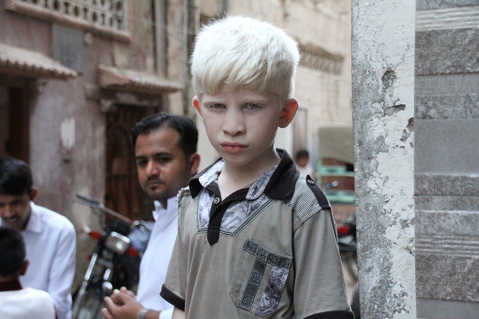 Niño con albinismo │Imagen tomada de: Pixabay Niño con albinismo │Imagen tomada de: Pixabay