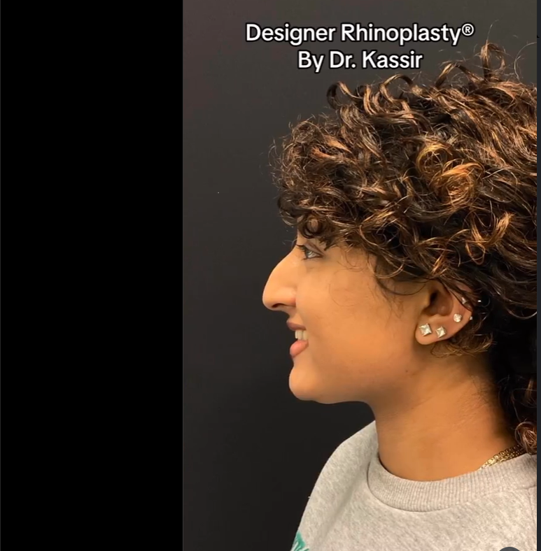 Patient before rhinoplasty, dated August 24, 2023 | Source: Instagram/drkassir