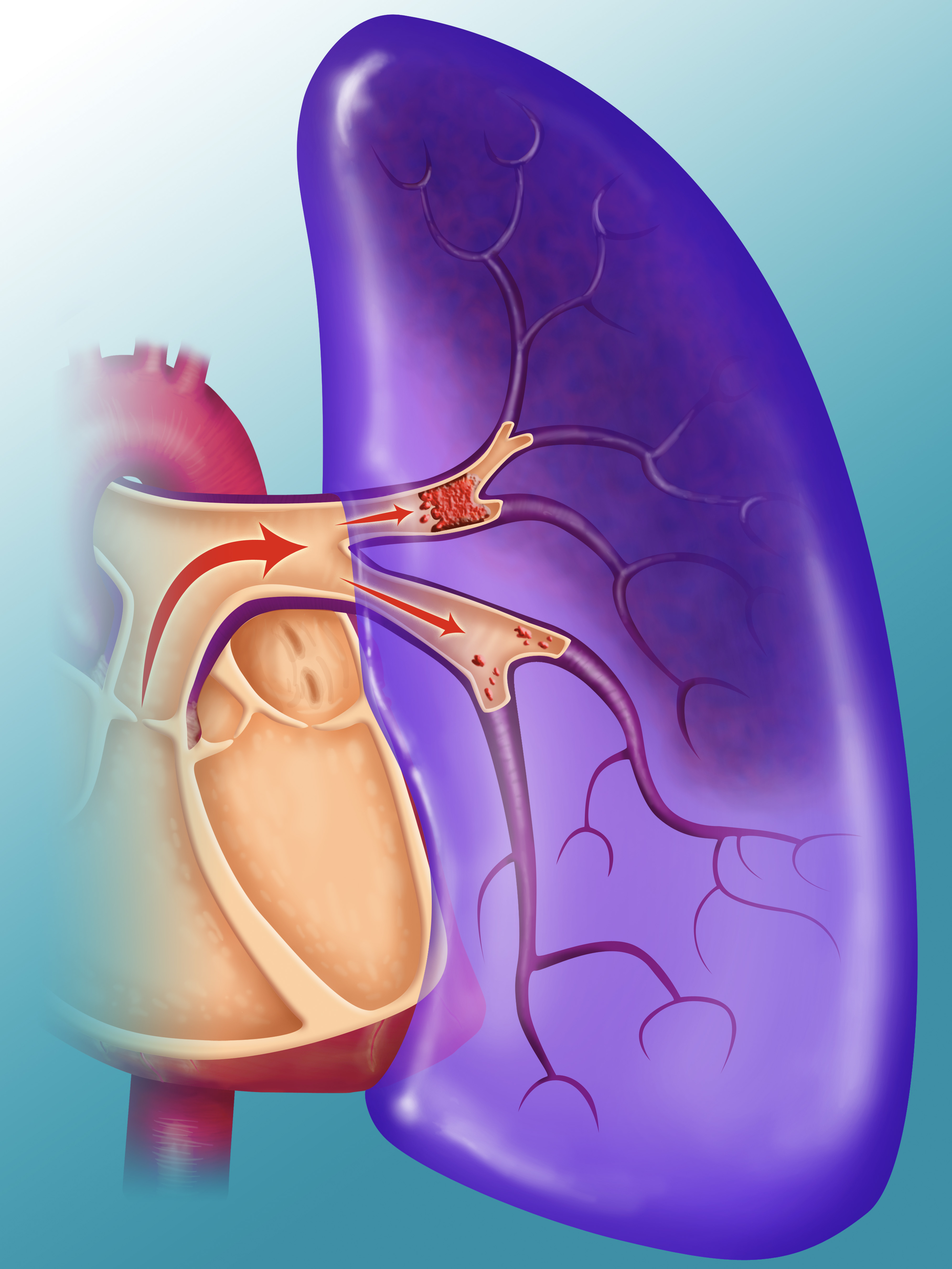 An illustration showing how a pulmonary embolism occurs | Source: Getty Images
