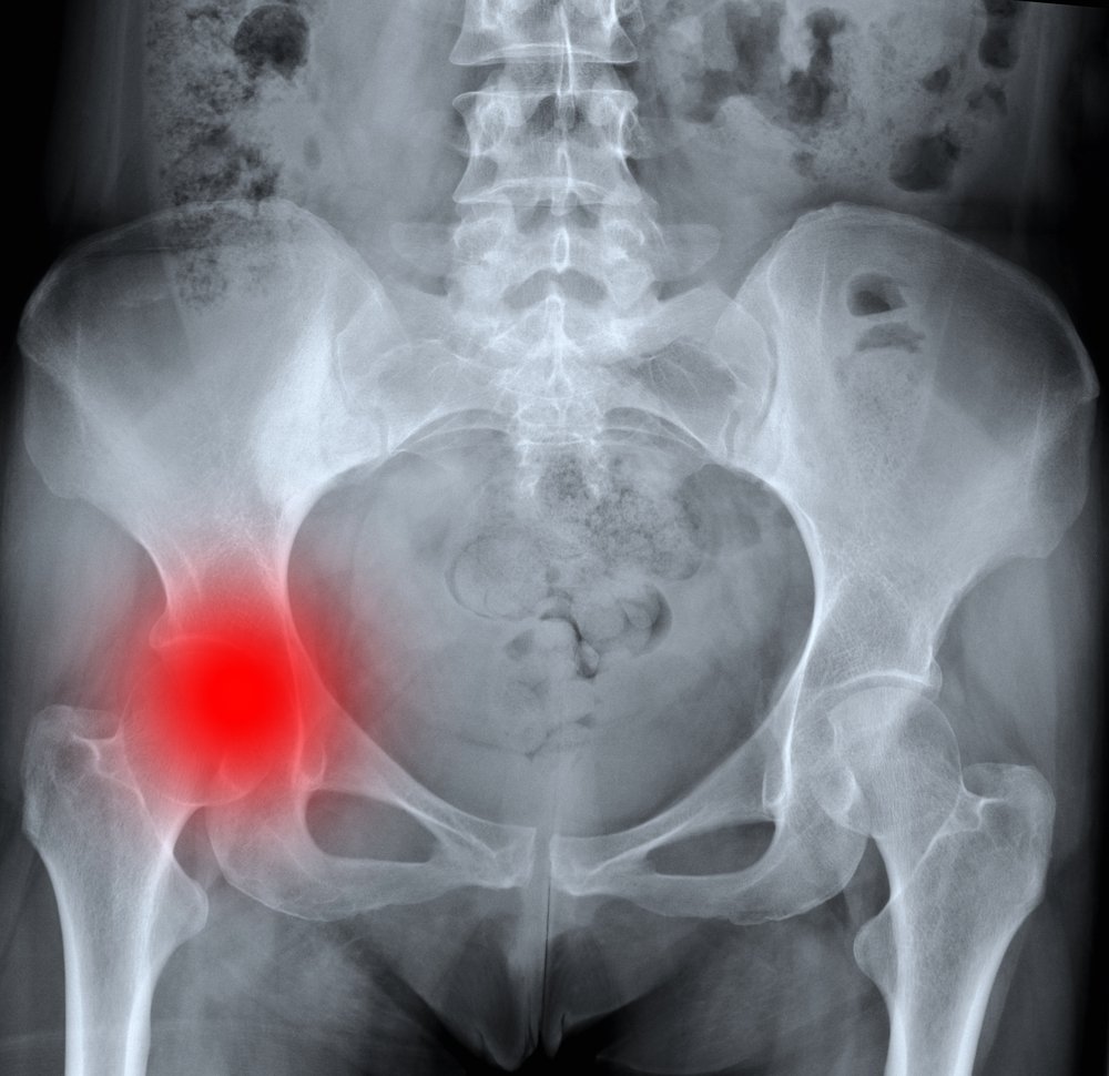Radiografía de cadera.| Imagen tomada de: Shutterstock