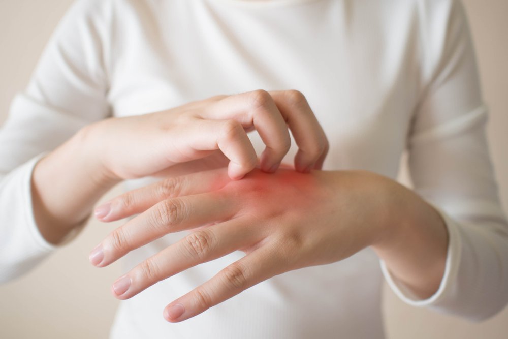Mujer con eczema en las manos. Fuente: Shutterstock
