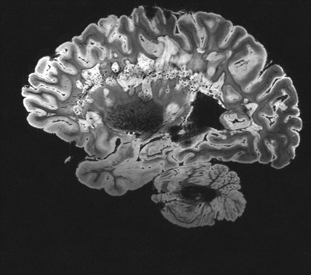 Resonancia magnética del cerebro. | Imagen: Flickr