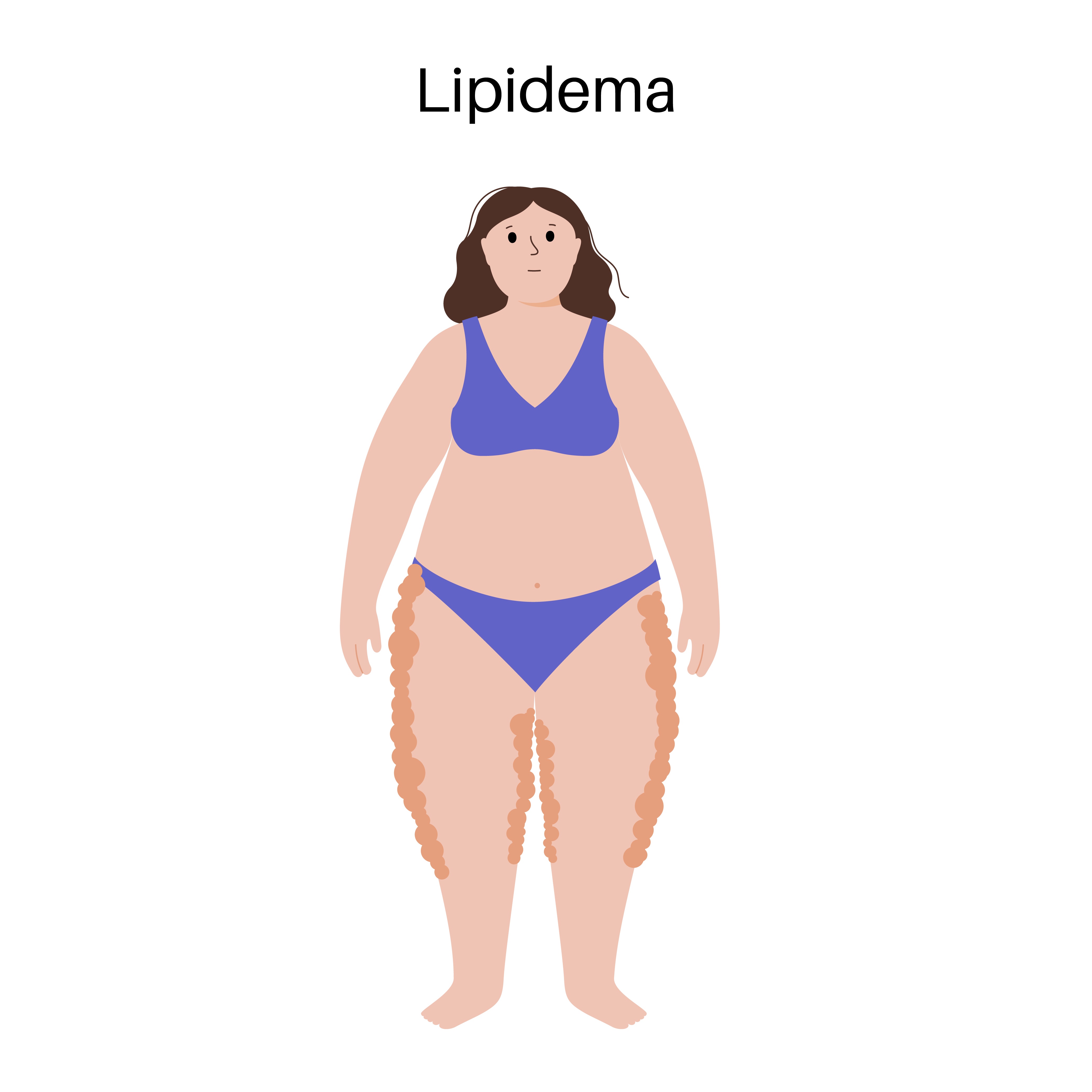 A flat vector illustration depicting the Lipedema disease concept: Abnormal fat accumulation in the lower body, affecting the buttocks, hips, and calves. Characterized by swelling, cellulite, and disproportionate weight gain | Source: Getty Images