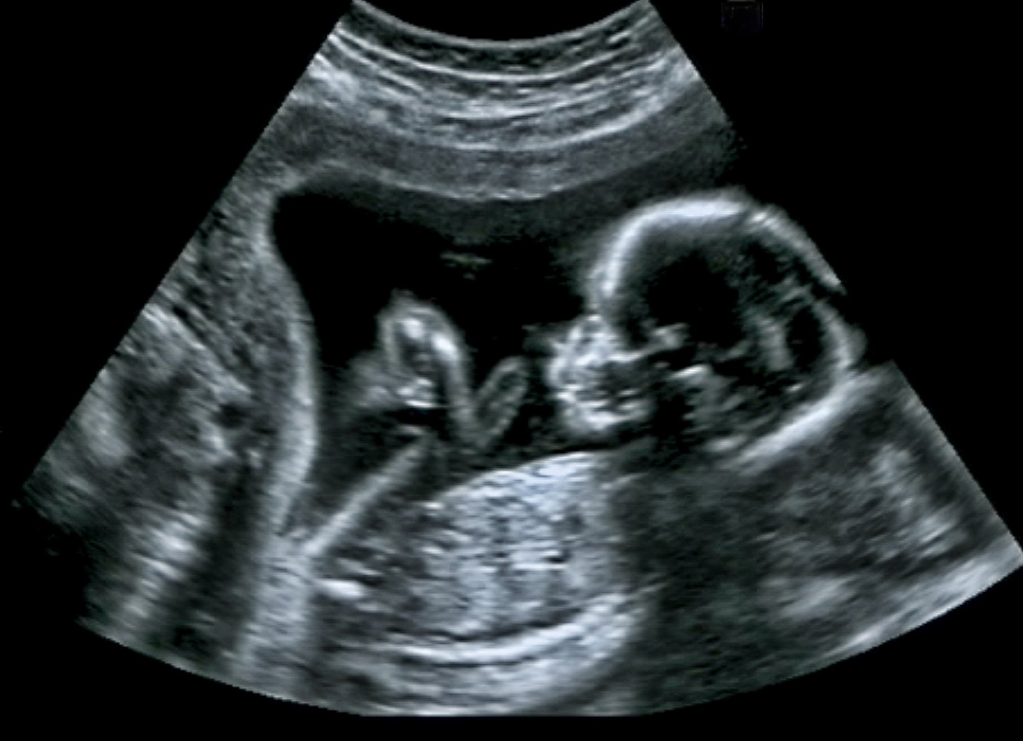 Sonograma de un embrión en el vientre. | Foto: Shutterstock