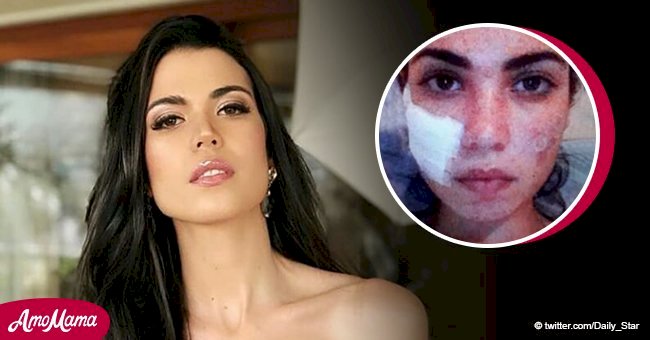 Miss Universe contestant reveals horror aesthetic procedure that nearly ended her career