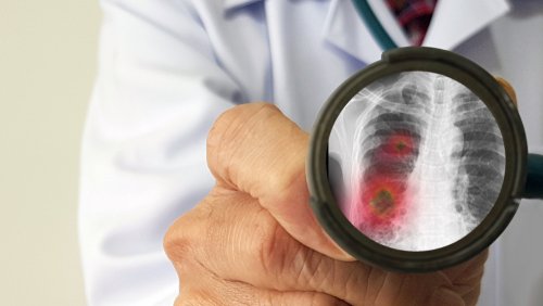Medico muestra en la lupa unos pulmones con coronavirus. | Foto: Shutterstock