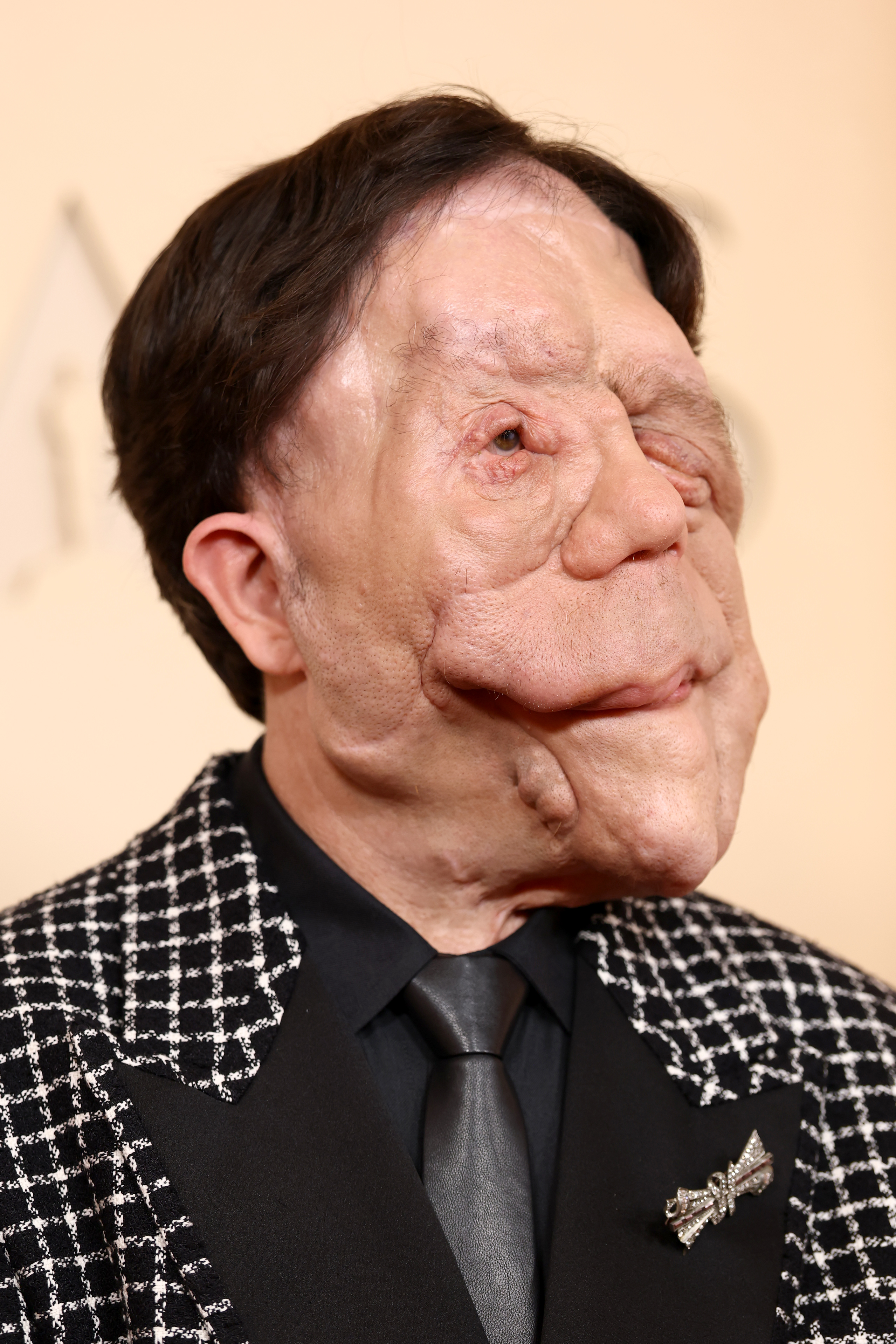 A close-up portrait of Adam Pearson on the red carpet at the 98th Academy Awards at the Dolby Theatre, Hollywood, California, on 15 March 2026. The image shows the full extent of the tumour growth across his face caused by neurofibromatosis type 1, the condition he was diagnosed with at the age of five. His chin is raised, and his gaze is directed upward and to the side.