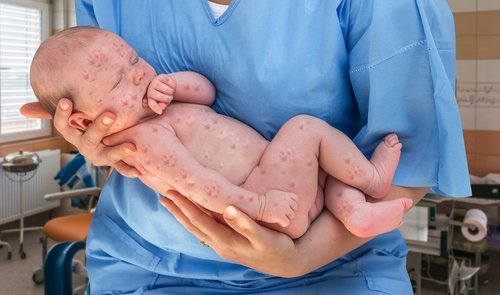 Newborn baby with chickenpox. | Source: Shutterstock.