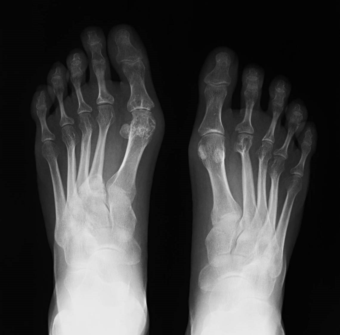 Placa de pies con artritis. | Imagen: Wikipedia